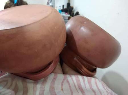 Esthetique et Remodlage des Fesses